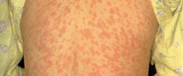 Δύο παιδιά στην εντατική με επιπλοκές από ιλαρά