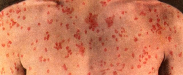 Αιφνίδια έξαρση ιλαρά έχει σημάνει συναγερμό στο Υπ. Υγείας