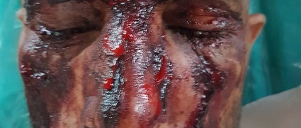 Με σιδερογροθιές χτύπησαν βάναυσα τον Πακιστανό μετανάστη