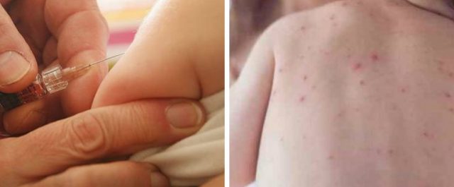 Πέθανε μωρό από ιλαρά!