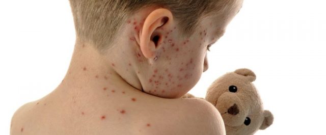 Πάνω από 200 τα κρούσματα ιλαράς- Πως έφθασε ο ιός στην Ελλάδα