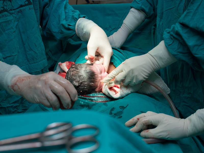 Προβληματική η ραγδαία αύξηση των τοκετών με καισαρική – Διεθνής ο σκεπτικισμός