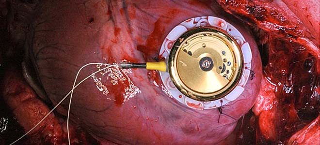 Δημιουργήθηκε ο πρώτος βηματοδότης χωρίς μπαταρία