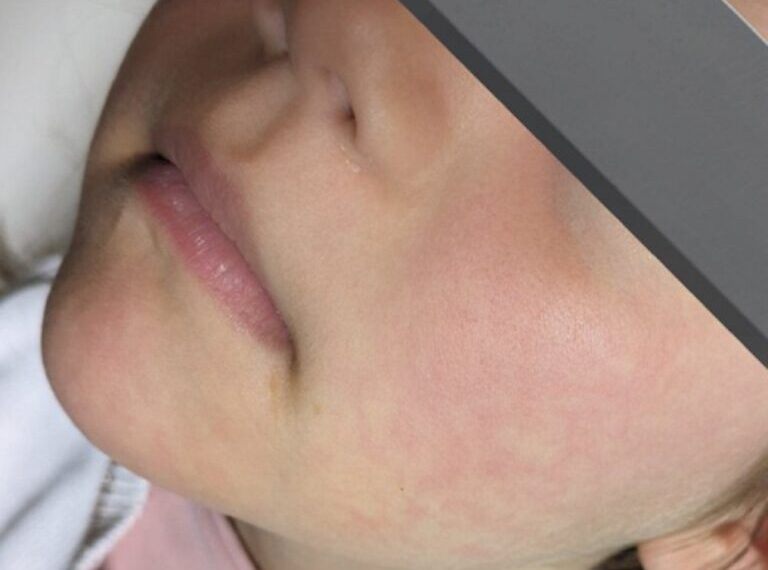 Παρβοϊός / Τι είναι και ποιοι κινδυνεύουν για σοβαρή νόσηση