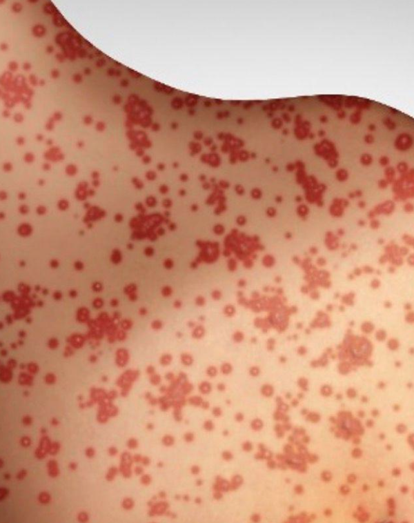 Επιδημία ιλαράς σαρώνει τις ΗΠΑ