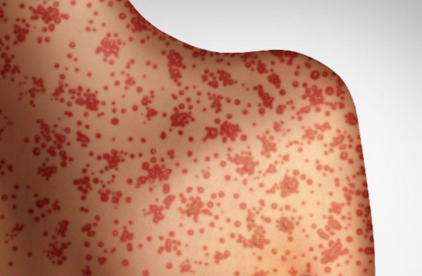 ΠΟΥ: Η χειρότερη επιδημία ιλαράς στην Ευρώπη από το 1997