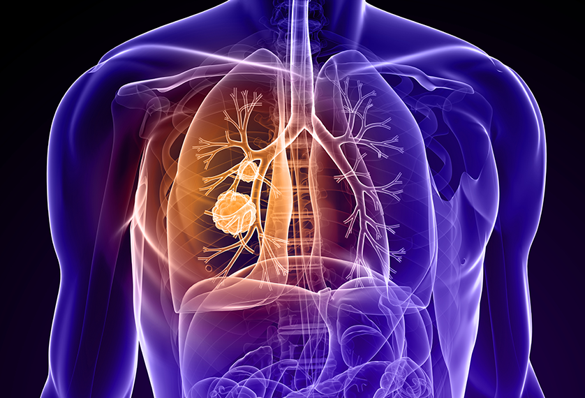 Παγκόσμια Ημέρα κατά του Καρκίνου: Ο καρκίνος του πνεύμονα είναι ο πιο θανατηφόρος στον πλανήτη