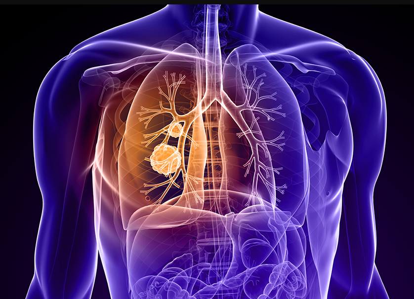 Παγκόσμια Ημέρα κατά του Καρκίνου: Ο καρκίνος του πνεύμονα είναι ο πιο θανατηφόρος&hellip;