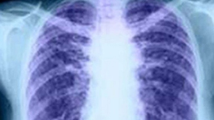 Σχεδόν τέσσερα εκατομμύρια πρόωροι θάνατοι από καρκίνο του πνεύμονα αποφεύχθηκαν στις ΗΠΑ λόγω της μείωσης του καπνίσματος