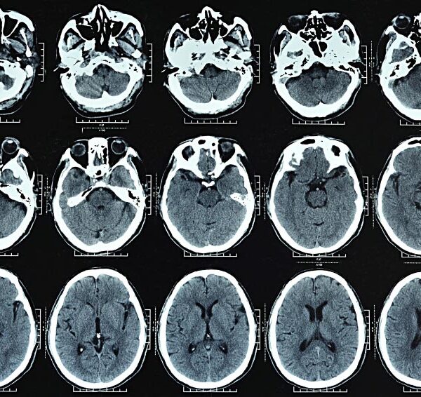 Αξονικές τομογραφίες: Προκαλούν το 5% των καρκίνων ετησίως 