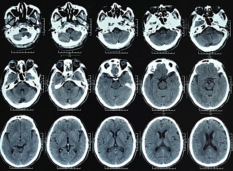 Αξονικές τομογραφίες: Προκαλούν το 5% των καρκίνων ετησίως 
