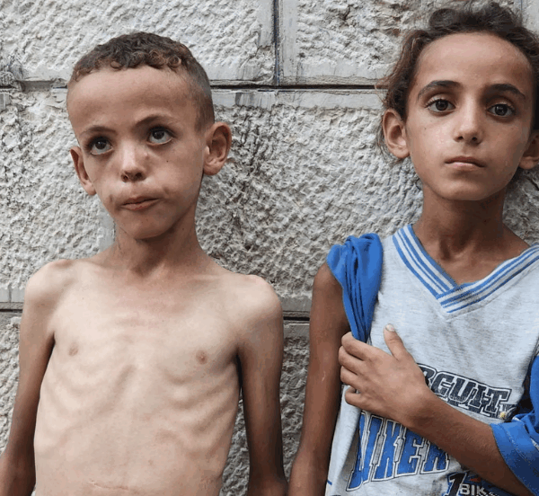 Γάζα: Σκελετωμένα παιδιά γεμίζουν νοσοκομεία