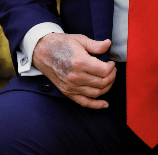 Ερωτήματα για την υγεία του Ντόναλντ Τραμπ μετά τις εμφανείς μελανιές στα&hellip;