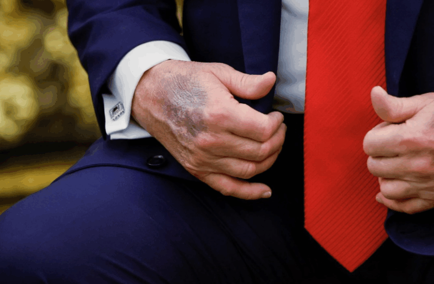 Ερωτήματα για την υγεία του Ντόναλντ Τραμπ μετά τις εμφανείς μελανιές στα χέρια του – Που οφείλονται