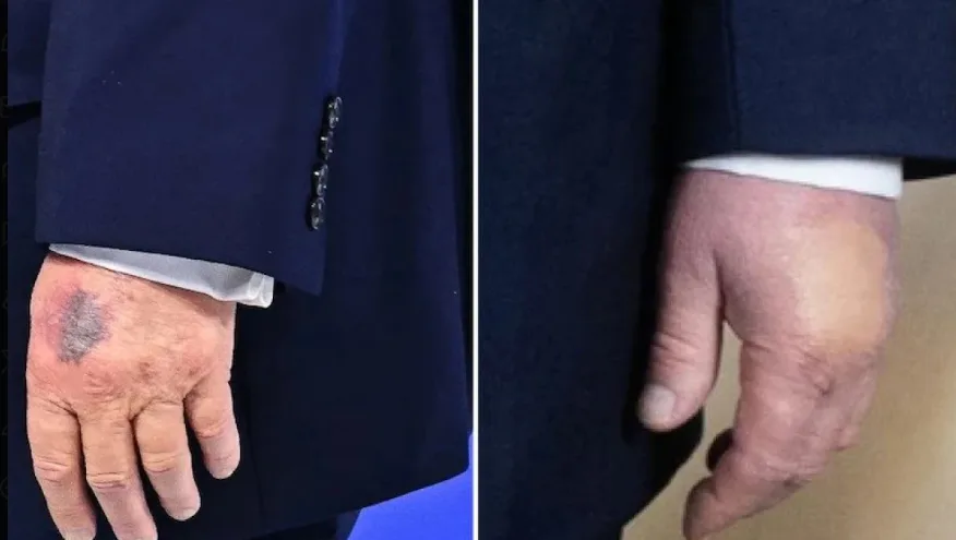 Όσο πάει και… μελανιάζει ο Τραμπ